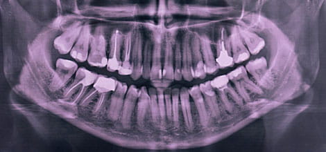 Dental X-ray